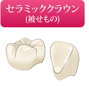 セラミッククラウン(被せもの)