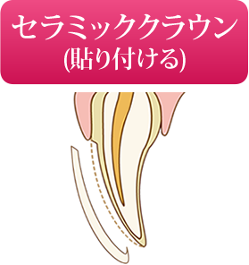 セラミッククラウン(貼り付ける)
